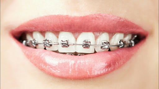 Vishnu Dhanvanthri Dental and Orthodontic Clinic (Metal braces/ceramic braces/Invisalign/Vivera retainers/aligners)
