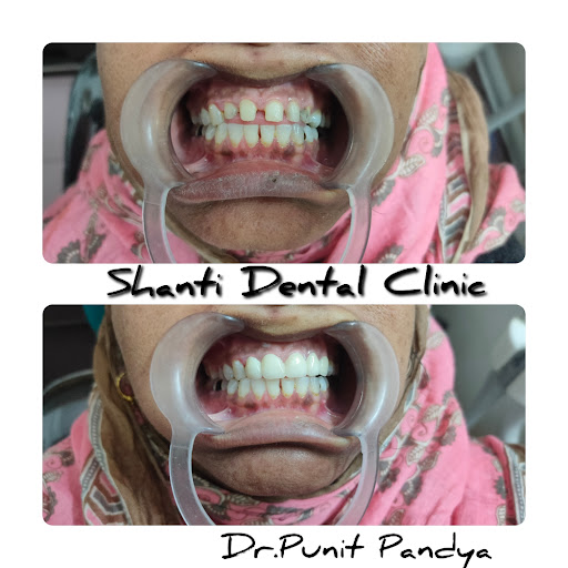 Shanti Dental Clinic by Dr Punit Pandya